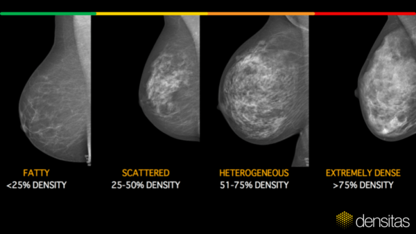 Operational efficiencies in mammography: Automated breast density assessment in alignment with ACR BIRADS5th ed Breast density scale