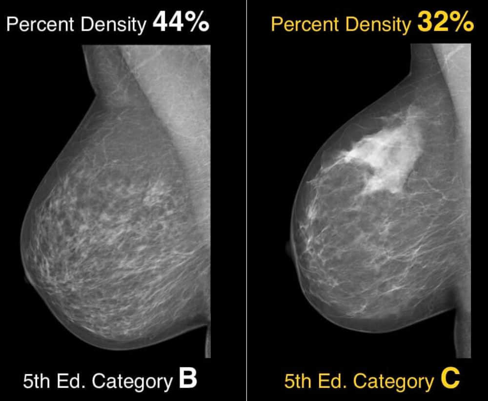 Image showing breast density percentage and ACR BIRADS 5th edition category C